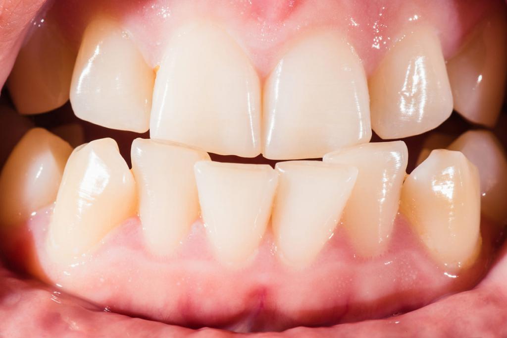 Анормална ухапване причинява заболяване на венците