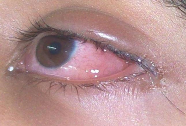 Leczenie alergią za pomocą Zodak Drops