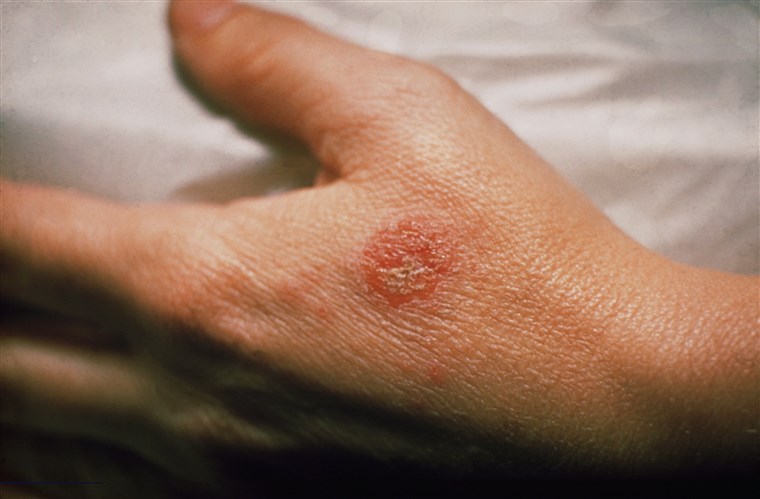 Eczema allergico