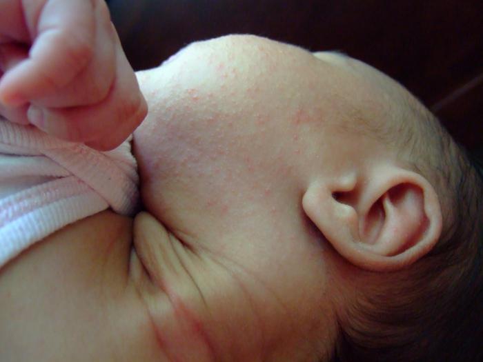 Eruzione di pannolino nel neonato sul collo