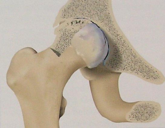 Uzroci i liječenje artroze ramena