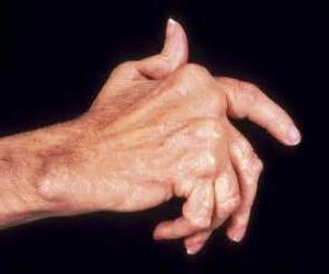 liječenje početne faze artroze ruku)