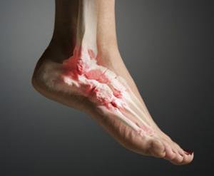 liječenje artroze stopala magnetom
