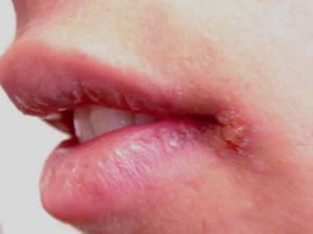 bułki w kącikach ust powodują