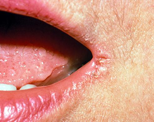 kako zdraviti bunice v kotih mazila za usta
