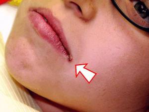 Kako liječiti buns u kutovima usta kod djece