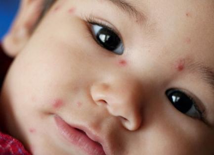 come trattare la varicella nei bambini