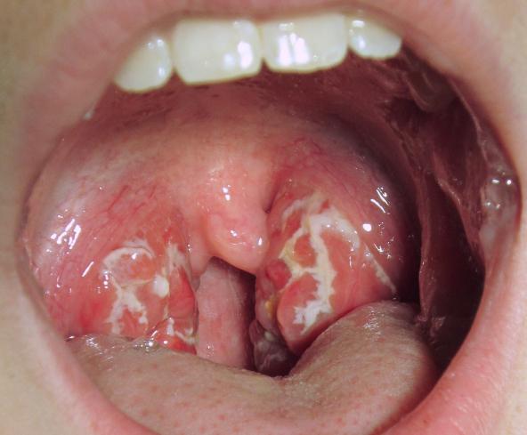 foto di tonsillite cronica