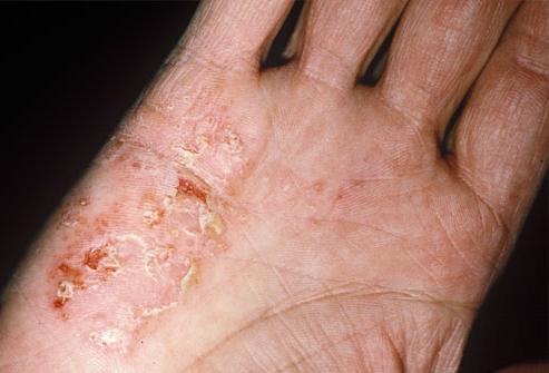 Eczema disidrotico