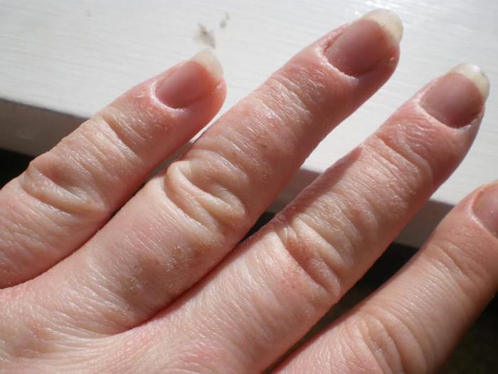 come trattare l'eczema sulle mani