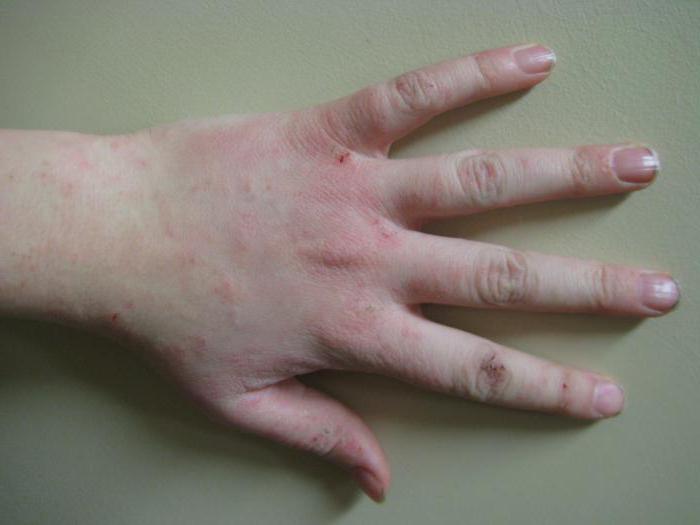 eczema sulle dita