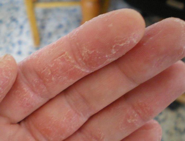 fase iniziale dell'eczema sulle mani
