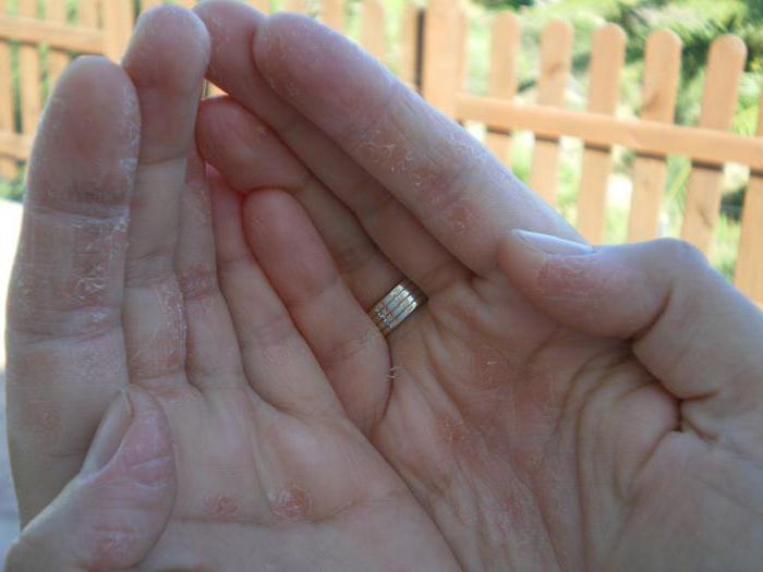 eczema della mano disidrotica