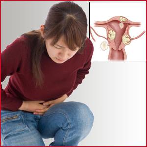 příznaky děložních fibroidů