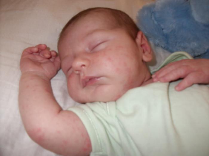 Jak zacházet s pichlavým teplem u kojenců