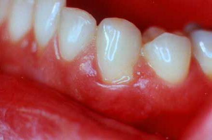 simptomi parodontalne bolezni