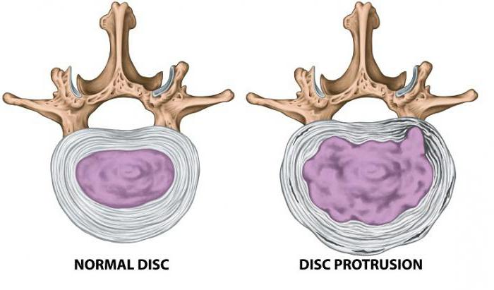 osteochondróza krční páteře s výčnělky disků