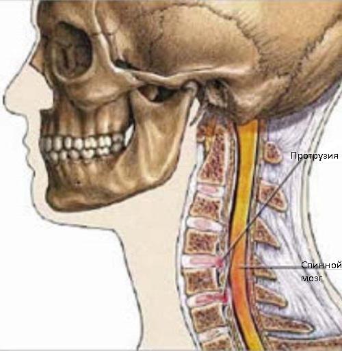 medvretenčna diskasta izboklina vratne hrbtenice