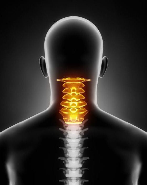 osteochondroza odcinka szyjnego kręgosłupa z występami dysków