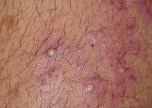infezione della pelle stafilococcica