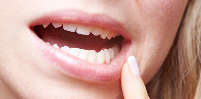 come trattare la stomatite in bocca