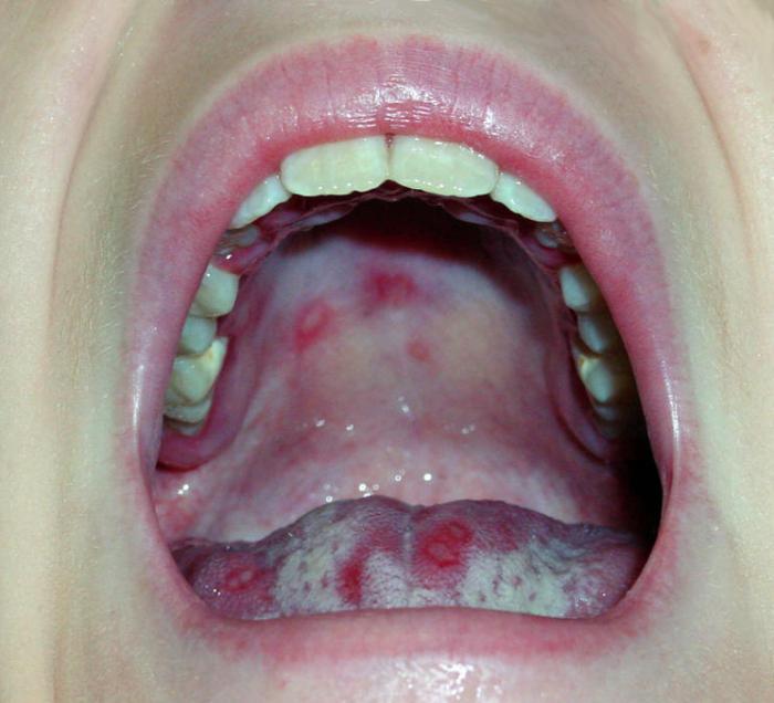 zdjęcie zapalenia jamy ustnej