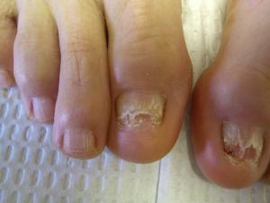 Kako za zdravljenje toenail glivice