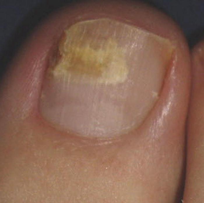 Lijek gljiva noktiju noktiju