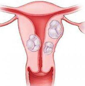 come trattare i fibromi uterini senza chirurgia