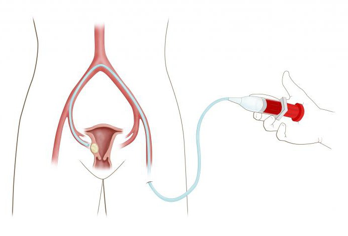 il mioma uterino può essere trattato senza chirurgia