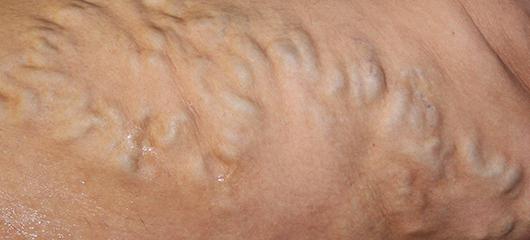 sintomi delle vene varicose