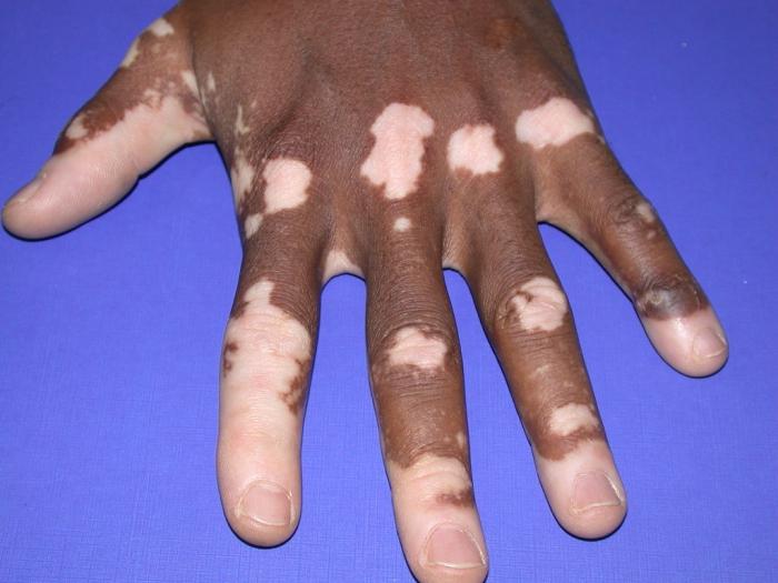 Jak zacházet s vitiligo