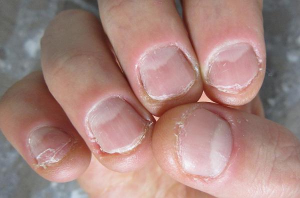последствия за ухапване на ноктите