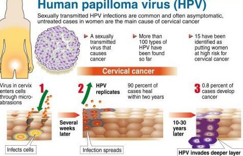 lidské papilomavirové infekce fotografie