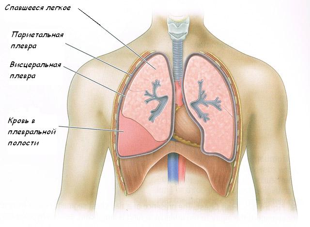 idrotorace del polmone destro