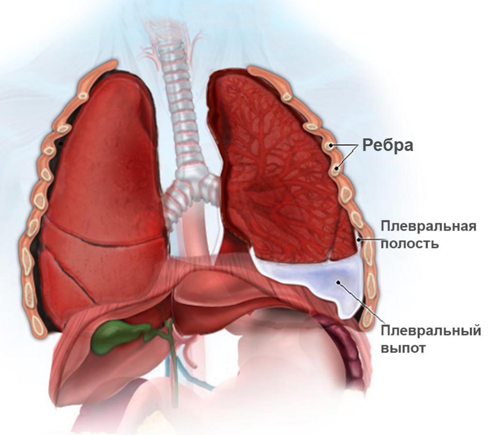 хидроторакс на белите дробове в онкологичната прогноза