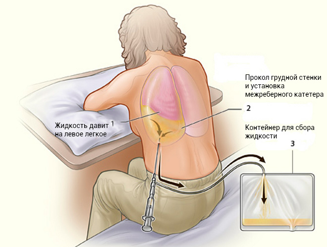 idrotorace polmonare bilaterale