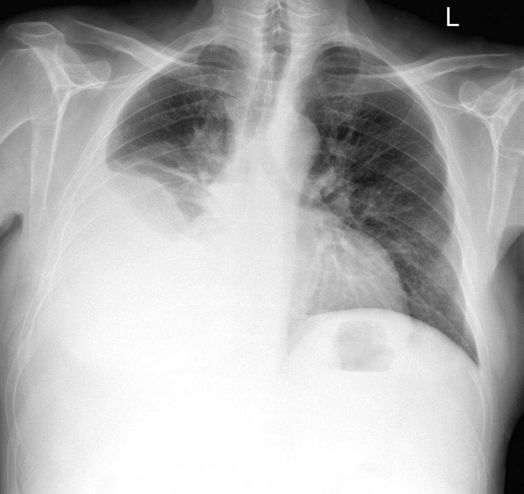 hydrothorax leczenia płuc