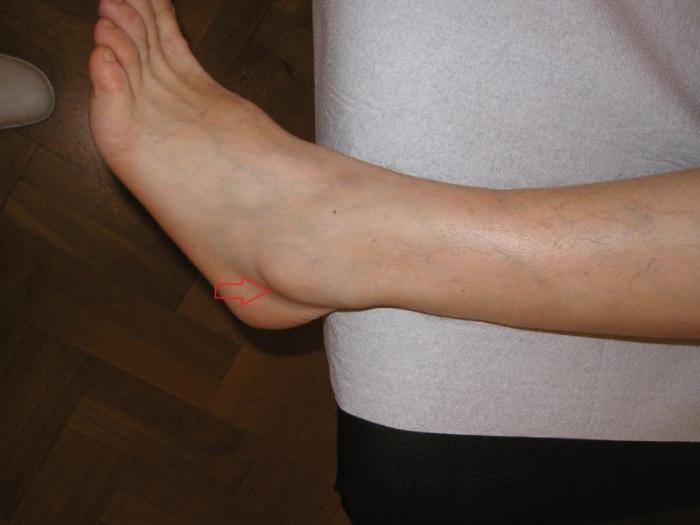 liječenje higrominom stopala