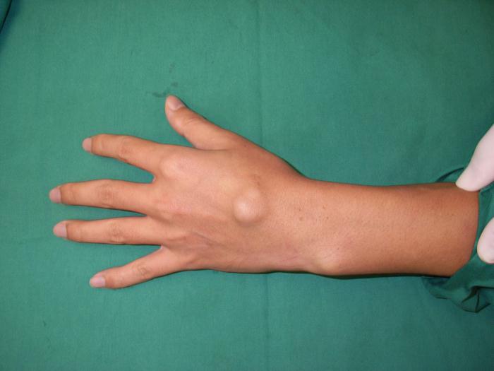 hygroma ručni zglob