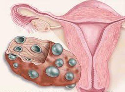 iperandrogenismo ovarico