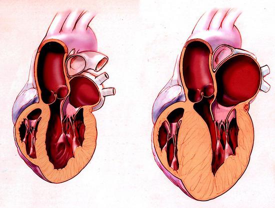 dismetabolna kardiomiopatija