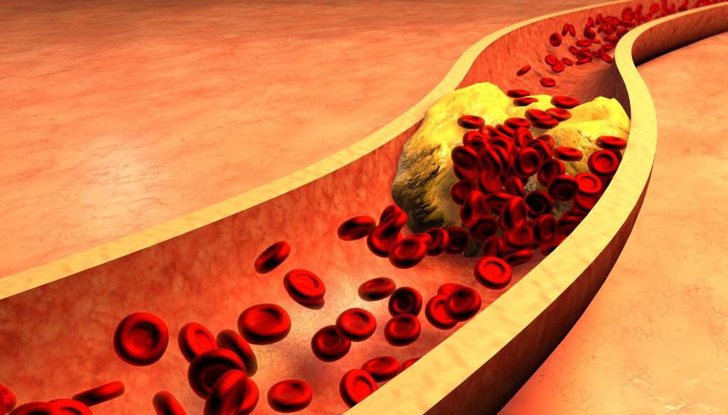 kolesterolni plakovi u krvnim žilama