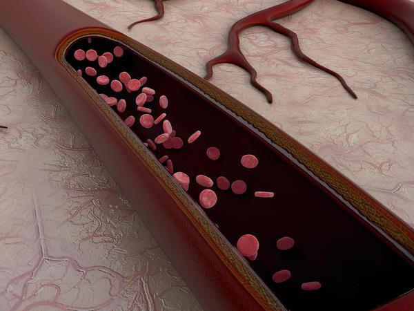 знакове интракранијалне хипоплазије леве вертебралне артерије