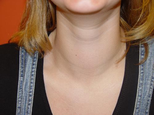 simptomi hipotiroidizma pri ženskah