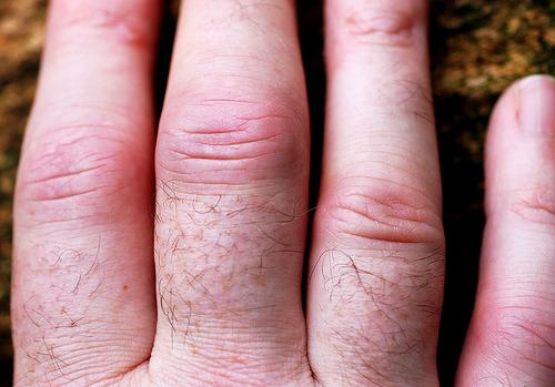 bol u zglobovima prstiju kada se pritisne meloksikam u liječenju osteoartritisa