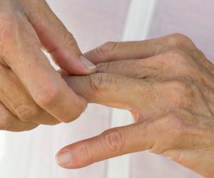 deform liječenje artritisa