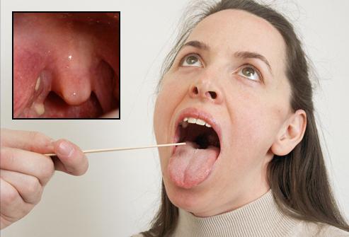 perché rimuovere le tonsille