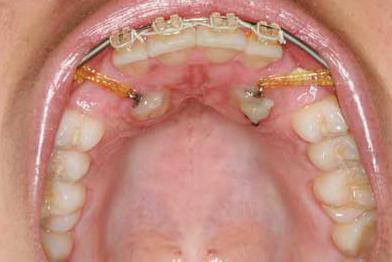 odstranitev udarjenega zoba