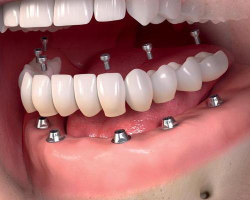 Mostek dentystyczny lub implant to lepsze recenzje